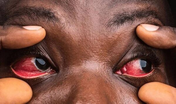 Silent Red-Eyes disease ravaging Busia citizens » Capital News