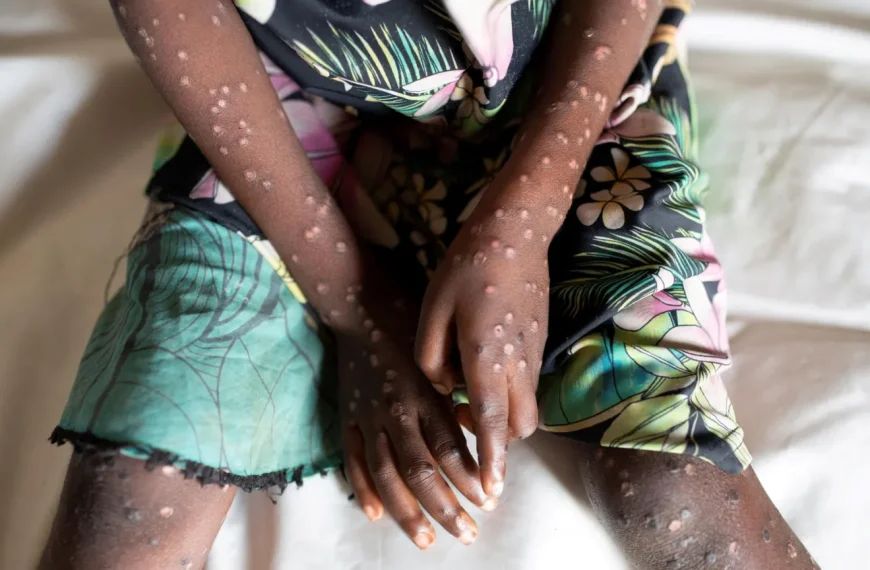 WHO declares Mpox global health emergency