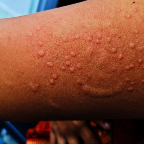 Government implements robust measures to prevent spread of Mpox virus
