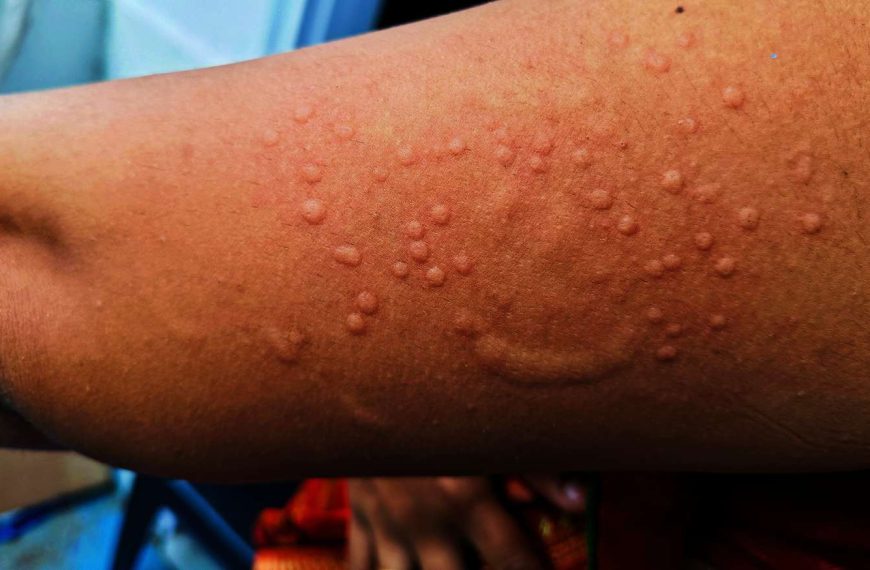 Mpox: Kenya screens 21,350 travellers, awaiting test results for six suspected cases
