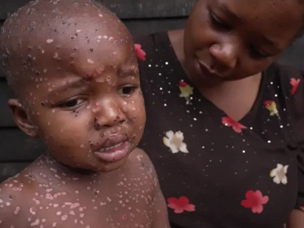 Children bearing the brunt of Mpox outbreak