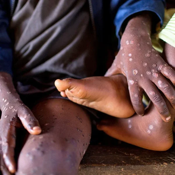 MPOX vaccine rollout set for December as Kenya ramps up surveillance