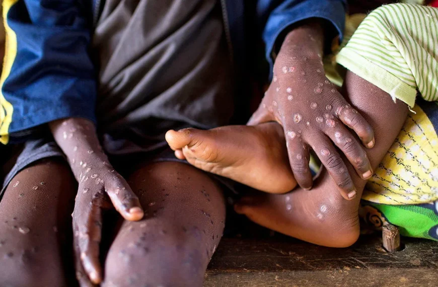 Mpox Update: Nakuru reports new case, total reaches 18